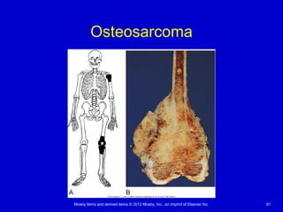 Mosby items and derived items © 2012 Mosby, Inc., an imprint of Elsevier Inc. 81
Osteosarcoma
 