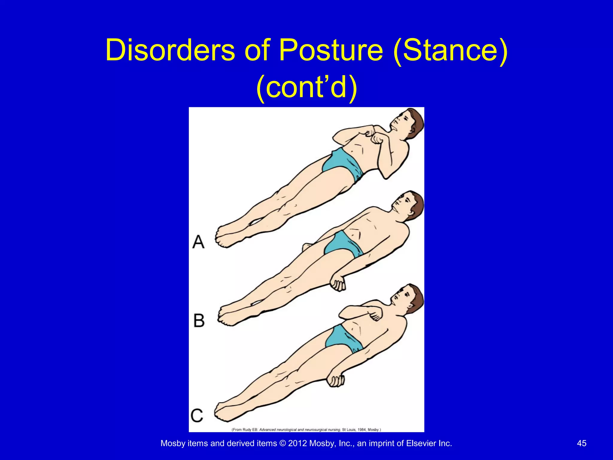 Mosby items and derived items © 2012 Mosby, Inc., an imprint of Elsevier Inc. 4545
Disorders of Posture (Stance)
(cont’d)
 