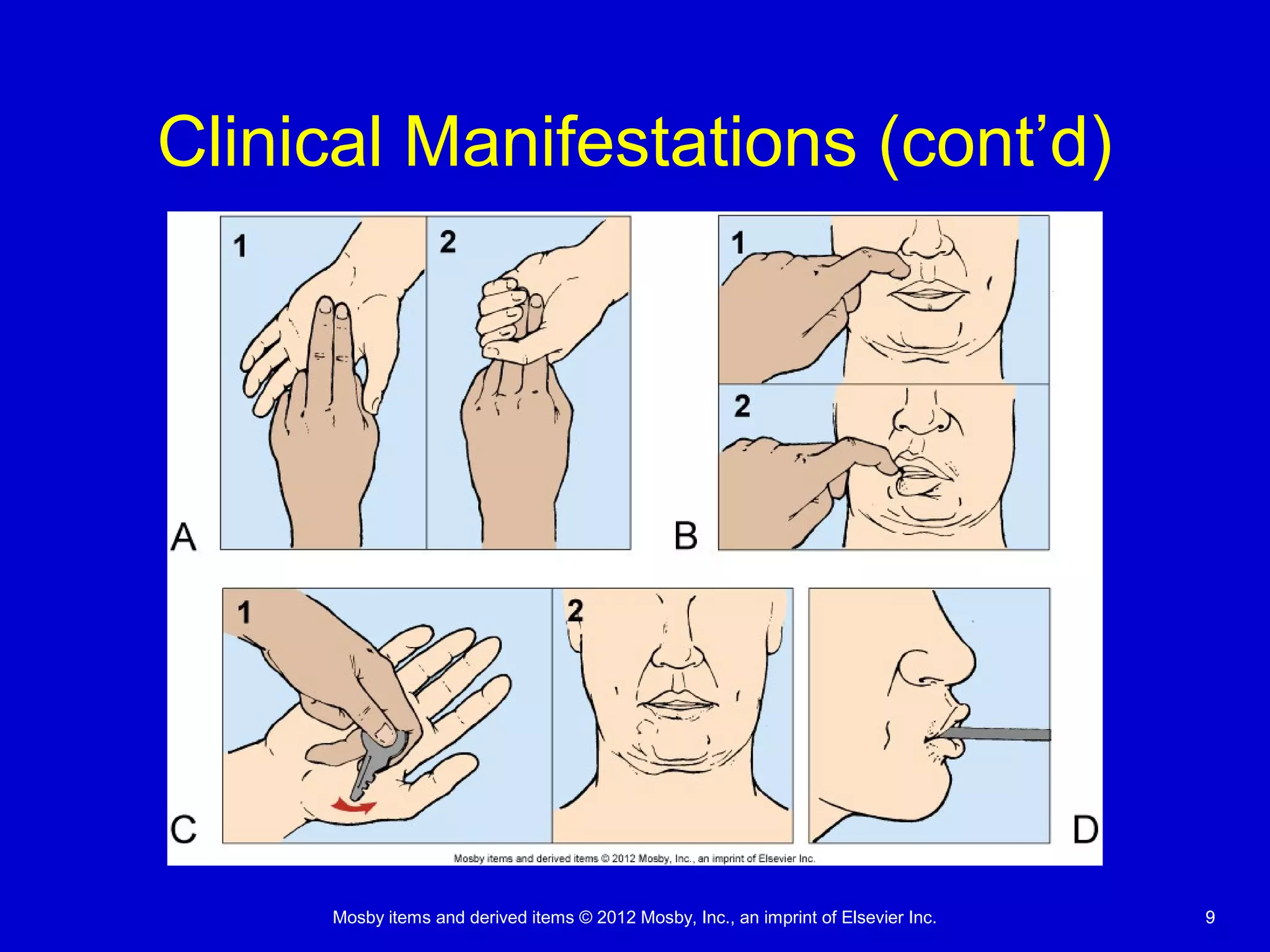 Mosby items and derived items © 2012 Mosby, Inc., an imprint of Elsevier Inc. 99
Clinical Manifestations (cont’d)
 