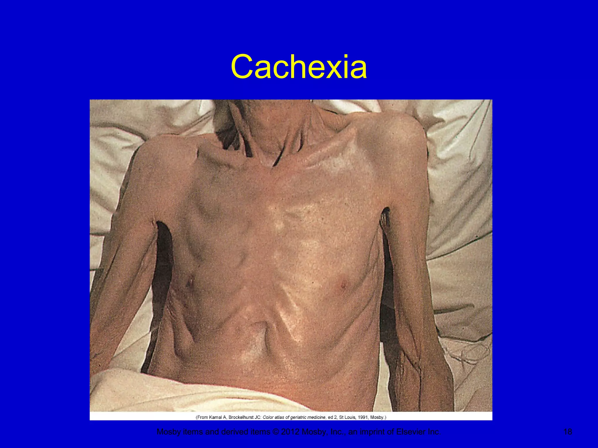 Mosby items and derived items © 2012 Mosby, Inc., an imprint of Elsevier Inc. 18
Cachexia
 