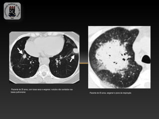 Paciente de 35 anos, com tosse seca e wegener; nodulos não cavitados nas
bases pulmonares                                                            Pacente de 45 anos, wegener e piora da respiração
 