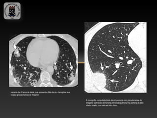 paciente de 40 anos de idade, que apresentou falta de ar e hemoptise leve,
biopsia granulomarose de Wegener

                                                                             A tomografia computadorizada de um paciente com granulomatose de
                                                                             Wegener conhecido demonstra um nódulo pulmonar na periferia do lobo
                                                                             inferior direito, com halo em vidro fosco
 