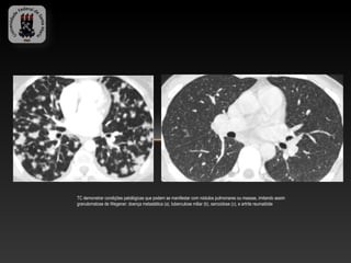 TC demonstrar condições patológicas que podem se manifestar com nódulos pulmonares ou massas, imitando assim
granulomatose de Wegener: doença metastática (a), tuberculose miliar (b), sarcoidose (c), e artrite reumatóide
 
