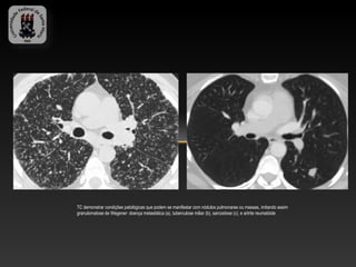 TC demonstrar condições patológicas que podem se manifestar com nódulos pulmonares ou massas, imitando assim
granulomatose de Wegener: doença metastática (a), tuberculose miliar (b), sarcoidose (c), e artrite reumatóide
 