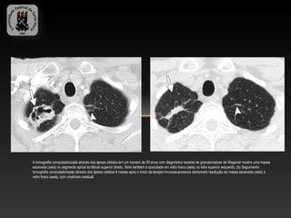 A tomografia computadorizada através dos ápices obtidos em um homem de 50 anos com diagnóstico recente de granulomatose de Wegener mostra uma massa
escavada (seta) no segmento apical do lóbulo superior direito. Note também a opacidade em vidro fosco (seta) no lobo superior esquerdo. (b) Seguimento
tomografia computadorizada através dos ápices obtidos 6 meses após o início da terapia imunossupressora demonstra resolução da massa escavada (seta) e
vidro fosco (seta), com cicatrizes residual.
 