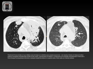 Paciente de 53 anos de idade, em que múltiplos cursos de terapia com antibióticos para suspeita de pneumonia - sem resposta. Achados em biópsia percutânea
guiada por tomografia computadorizada da lesão do lobo superior (granulomatose de Wegener). (b) Seguimento com tomografia computadorizada 9 meses após o
início da terapia imunossupressora demonstra a resolução completa das lesões em a esquerda (seta) e direito (seta) com cicatrizes residuais.
 