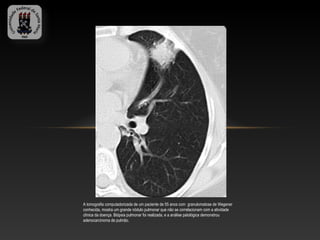 A tomografia computadorizada de um paciente de 55 anos com granulomatose de Wegener
conhecida, mostra um grande nódulo pulmonar que não se correlacionam com a atividade
clínica da doença. Biópsia pulmonar foi realizada, e a análise patológica demonstrou
adenocarcinoma de pulmão.
 