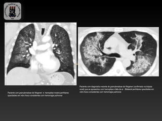 Paciente com diagnóstico recente de granulomatose de Wegener (confirmado na biópsia
                                                                       renal) que se apresentou com hemoptise e falta de ar . Biilateral perihilares opacidades em
Paciente com granulomatose de Wegener e hemoptise mostra perihilares   vidro fosco consistentes com hemorragia pulmonar.
opacidades em vidro fosco consistentes com hemorragia pulmonar.
 