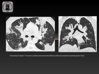 Granulomatose de Wegener. TC demonstra opacidades peribroncovasculares bilaterais e periférica que representam exacerbação aguda da doença.
 