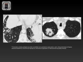 TC demonstrar condições patológicas que podem se manifestar como opacidades do espaço aéreo e, assim, imitar granulomatose de Wegener:
pneumonia bacteriana (a), pneumonia por aspiração (b), pneumonia em organização (c) e adenocarcinoma de pulmão primário(d).
 