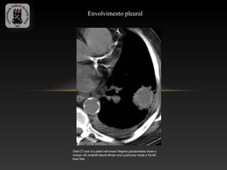 Envolvimento pleural




Chest CT scan of a patient with known Wegener granulomatosis shows a
nonspe- cific small left pleural effusion and a pulmonary nodule in the left
lower lobe.
 