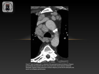 Chest CT scan of a patient with in- volvement of the paranasal sinuses and kidneys by Wegener
granulomatosis who presented with wors- ening renal function shows extensive mediastinal
adenopathy. Results of biopsy performed to exclude malignancy proved that the adenopathy was
second- ary toWegener granulomatosis.
 