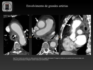 Envolvimento de grandes artérias




Axial TC ao nível do arco aórtico (a) artéria pulmonar direita (b) e sagital reformatada CT imagem (c) obtido em um paciente de 45 anos de idade, com
conhecida granulomatose de Wegener mostram extensa peri aortite-(setas).
 