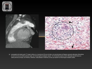 (a) parassagital reformatado peito CT imagem obtida em um paciente de 56 anos de idade, com granulomatose de Wegener apresenta alterações inflamatórias
    em torno do tronco da artéria pulmonar (seta). (b) Fotomicrografia (ampliação original, × 63; hematoxilina-eosina) mostra inflamação granulomatosa na
    artéria pulmonar principal, com linfócitos, histiócitos, multinucleadas e histiócitos (círculo) que separam as fibras largas de elástico (setas).
 