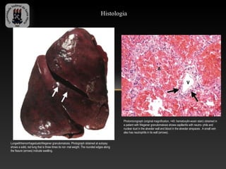 Histologia




                                                                                           Photomicrograph (original magnification, ×40; hematoxylin-eosin stain) obtained in
                                                                                           a patient with Wegener granulomatosis shows capillaritis with neutro- phils and
                                                                                           nuclear dust in the alveolar wall and blood in the alveolar airspaces . A small vein
                                                                                           also has neutrophils in its wall (arrows).


LungwithhemorrhageduetoWegener granulomatosis. Photograph obtained at autopsy
shows a solid, red lung that is three times its nor- mal weight. The rounded edges along
the fissure (arrows) indicate swelling.
 