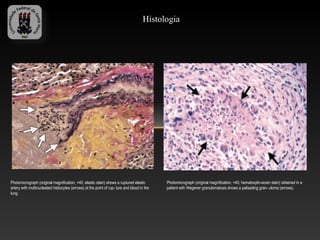 Histologia




Photomicrograph (original magnification, ×40; elastic stain) shows a ruptured elastic        Photomicrograph (original magnification, ×40; hematoxylin-eosin stain) obtained in a
artery with multinucleated histiocytes (arrows) at the point of rup- ture and blood in the   patient with Wegener granulomatosis shows a palisading gran- uloma (arrows).
lung.
 