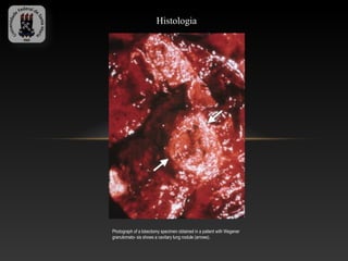 Histologia




Photograph of a lobectomy specimen obtained in a patient with Wegener
granulomato- sis shows a cavitary lung nodule (arrows).
 