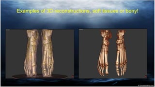 Examples of 3D reconstructions, soft tissues or bony!
 