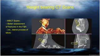 Weight bearing CT Scans
- WBCT Scans :
– Better assessment
of fractures in the F&A
( ex., lateral process of
talus)
 
