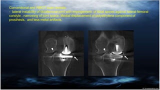 Conventional and WBCT scan reveals:
- lateral instability of tibiofemoral joint with impingement of tibial spines against ...