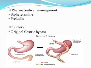 Pharmaceutical management
• Biphetetamine
• Preludin
 Surgery
• Original Gastric bypass
 