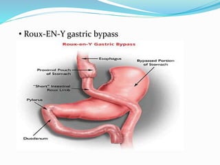 • Roux-EN-Y gastric bypass
 