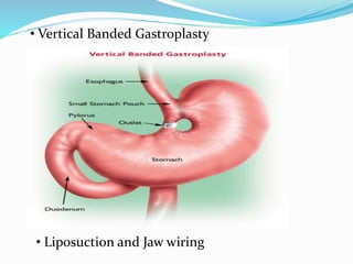 • Vertical Banded Gastroplasty
• Liposuction and Jaw wiring
 