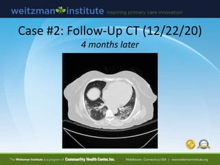 Case #2: Follow-Up CT (12/22/20)
4 months later
 