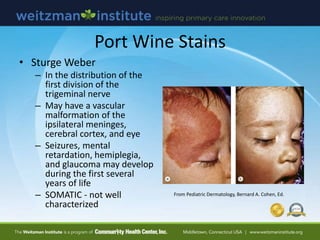 Port Wine Stains
• Sturge Weber
– In the distribution of the
first division of the
trigeminal nerve
– May have a vascular
malformation of the
ipsilateral meninges,
cerebral cortex, and eye
– Seizures, mental
retardation, hemiplegia,
and glaucoma may develop
during the first several
years of life
– SOMATIC - not well
characterized
From Pediatric Dermatology, Bernard A. Cohen, Ed.
 
