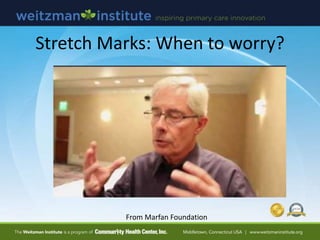 Stretch Marks: When to worry?
From Marfan Foundation
 