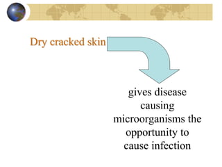 Dry cracked skinDry cracked skin
gives disease
causing
microorganisms the
opportunity to
cause infection
 