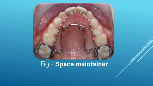 Tooth Screen Oral screen and mixed dentition appliance | PPT