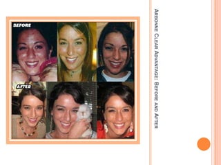 ARBONNECLEARADVANTAGE:BEFOREANDAFTER
 