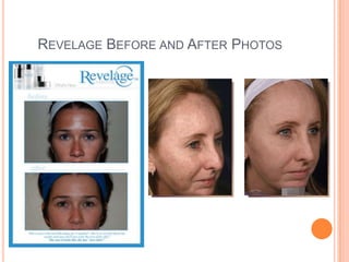 REVELAGE BEFORE AND AFTER PHOTOS
 