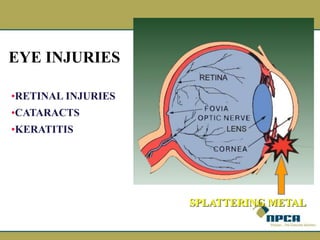 •RETINAL INJURIES
•CATARACTS
•KERATITIS
SPLATTERING METAL
EYE INJURIES
 