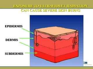 EXPOSURE TO ULTRAVIOLET RADIATION
CAN CAUSE SEVERE SKIN BURNS
EPIDERMIS
DERMIS
SUBDERMIS
 