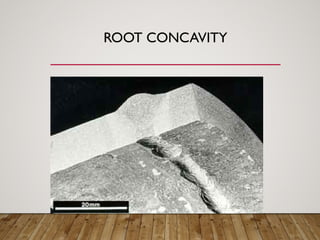 ROOT CONCAVITY
 