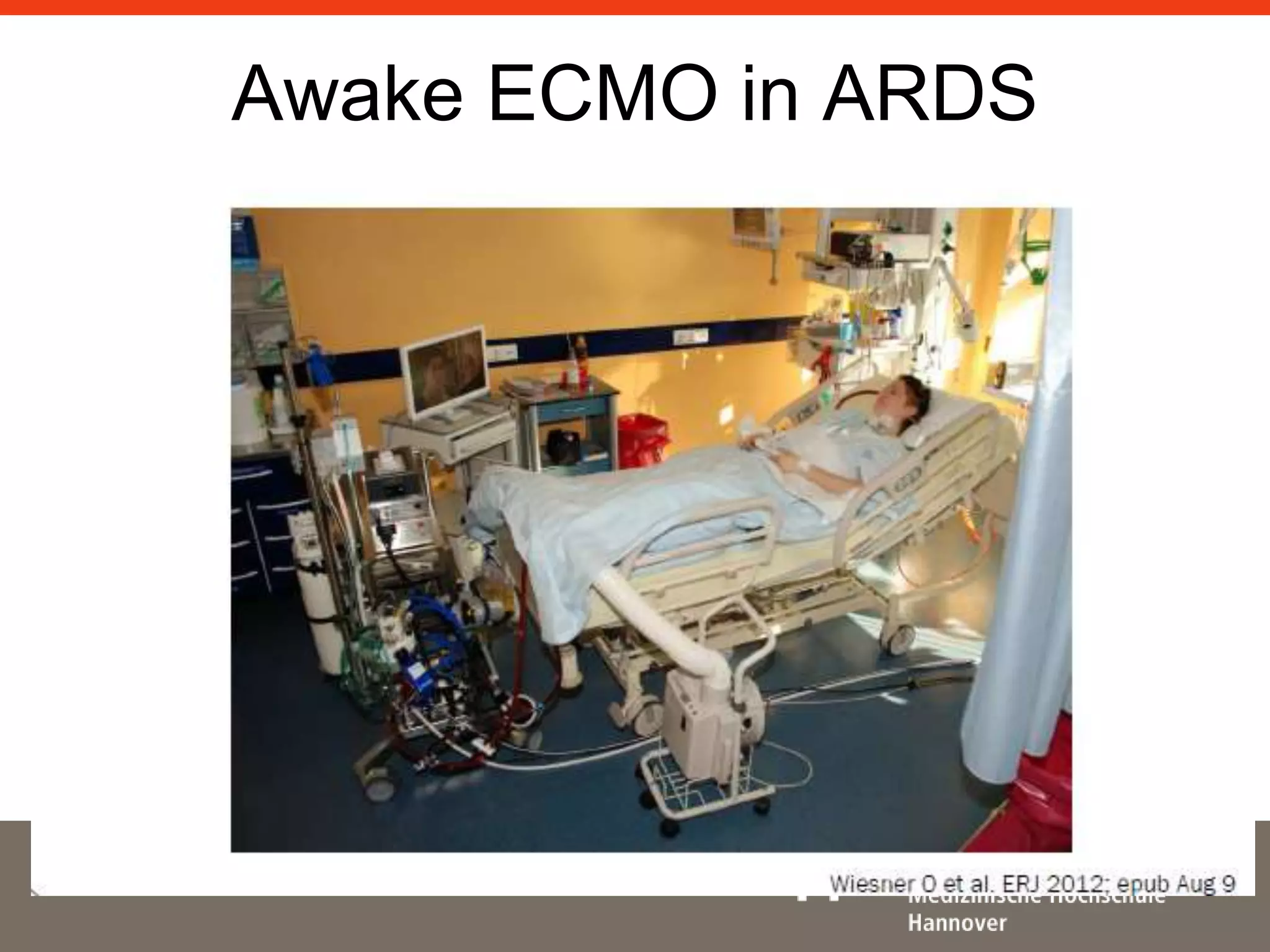 Awake ECMO in ARDS 
 