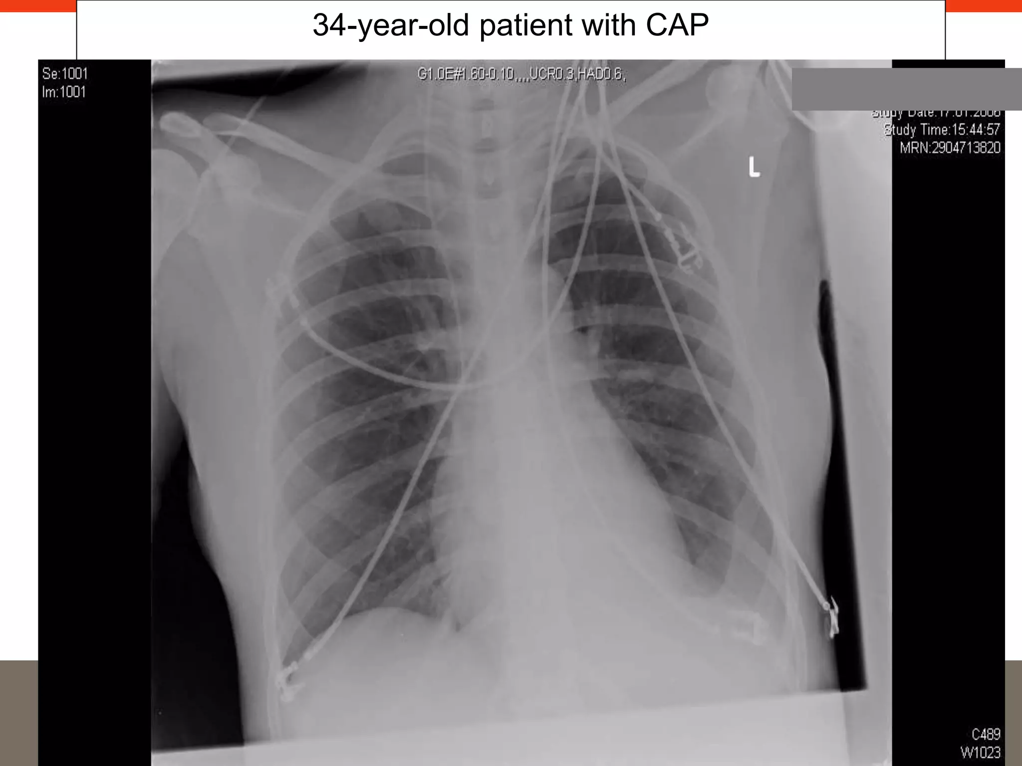 34-year-old patient with CAP 
 
