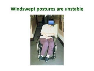 Windswept postures are unstable
 