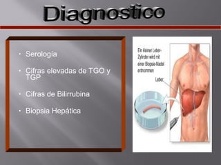 •

Serología

•

Cifras elevadas de TGO y
TGP

•

Cifras de Bilirrubina

•

Biopsia Hepática

 