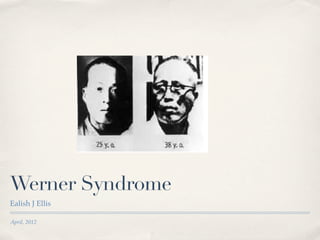 Werners Syndrome Before And After werners-syndrome-before-and-after