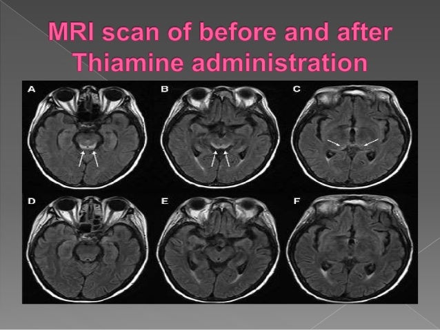 Wernicke’s encephalopathy