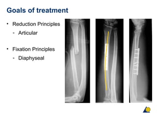 Goals of treatment
• Reduction Principles
- Articular
• Fixation Principles
- Diaphyseal
 