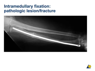 Intramedullary fixation:
pathologic lesion/fracture
 