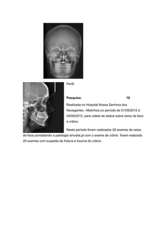 Perfil:

Pesquisa:

10

Realizada no Hospital Nossa Senhora dos
Navegantes –Matinhos,no período de 01/08/2012 à
04/08/2012, para coleta de dados sobre seios da face
e crânio.
Neste período foram realizados 28 exames de seios
da face,constatando a patologia sinusite,já com o exame de crânio foram realizado
20 exames com suspeita de fratura e trauma do crânio.

 