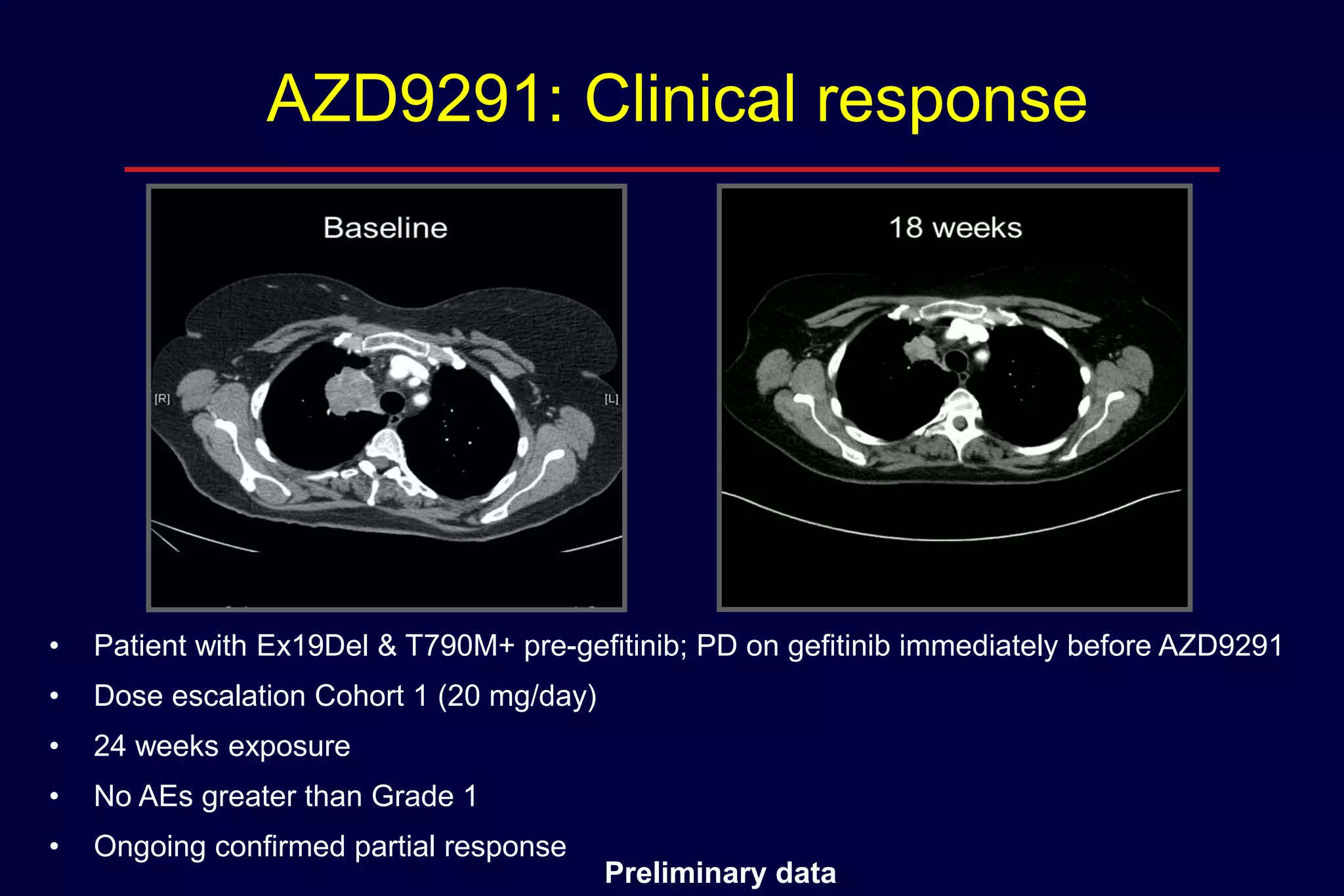 AZD9291: Clinical response

•

Patient with Ex19Del & T790M+ pre-gefitinib; PD on gefitinib immediately before AZD9291

•

Dose escalation Cohort 1 (20 mg/day)

•

24 weeks exposure

•

No AEs greater than Grade 1

•

Ongoing confirmed partial response

Preliminary data

 