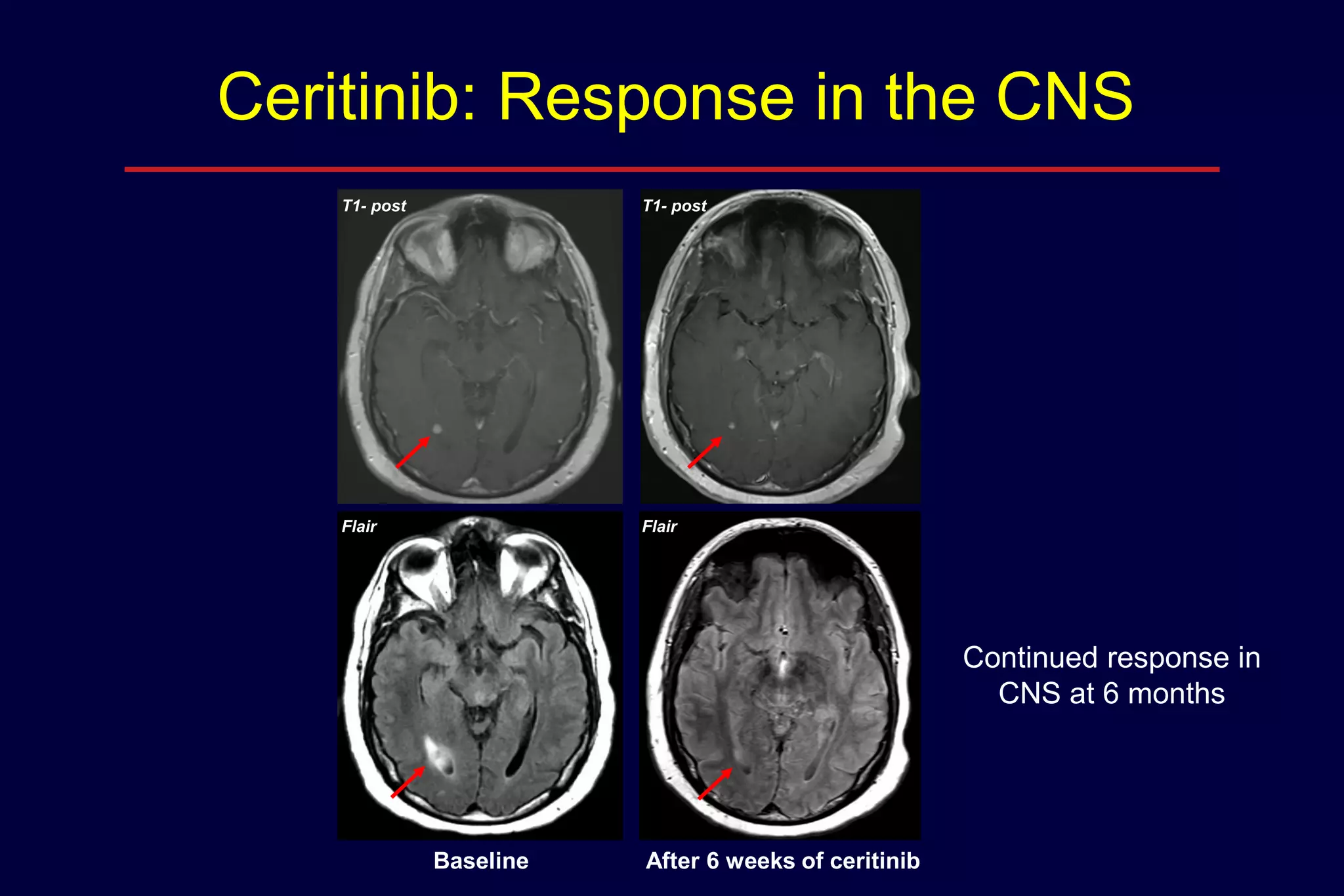 Ceritinib: Response in the CNS
T1- post

T1- post

Flair

Flair

Continued response in
CNS at 6 months

Baseline

After 6 weeks of ceritinib

 