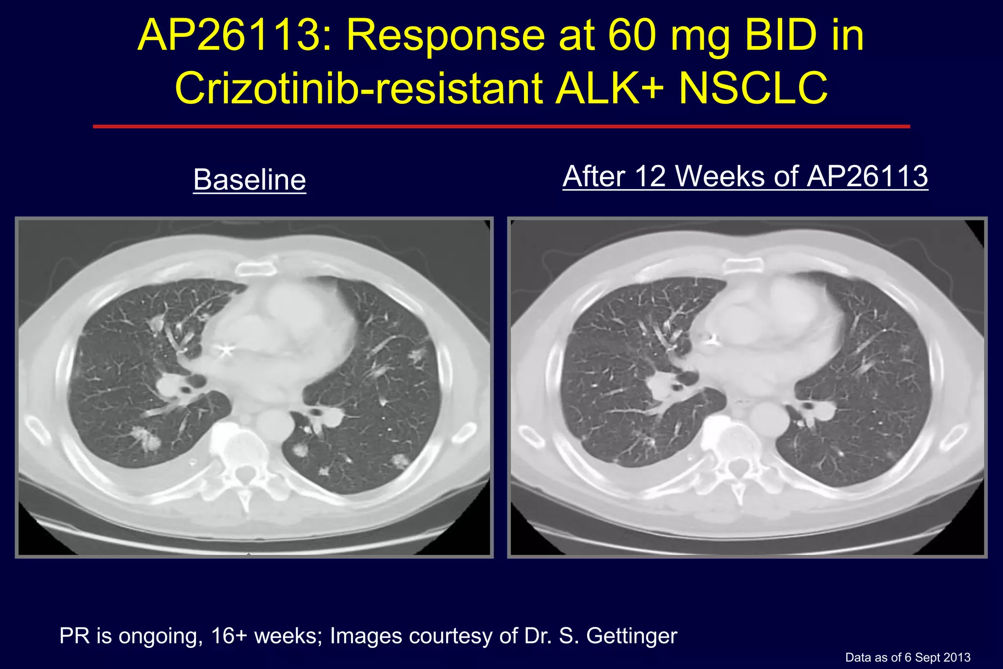 AP26113: Response at 60 mg BID in
Crizotinib-resistant ALK+ NSCLC
Baseline

After 12 Weeks of AP26113

PR is ongoing, 16+ weeks; Images courtesy of Dr. S. Gettinger
Data as of 6 Sept 2013

 