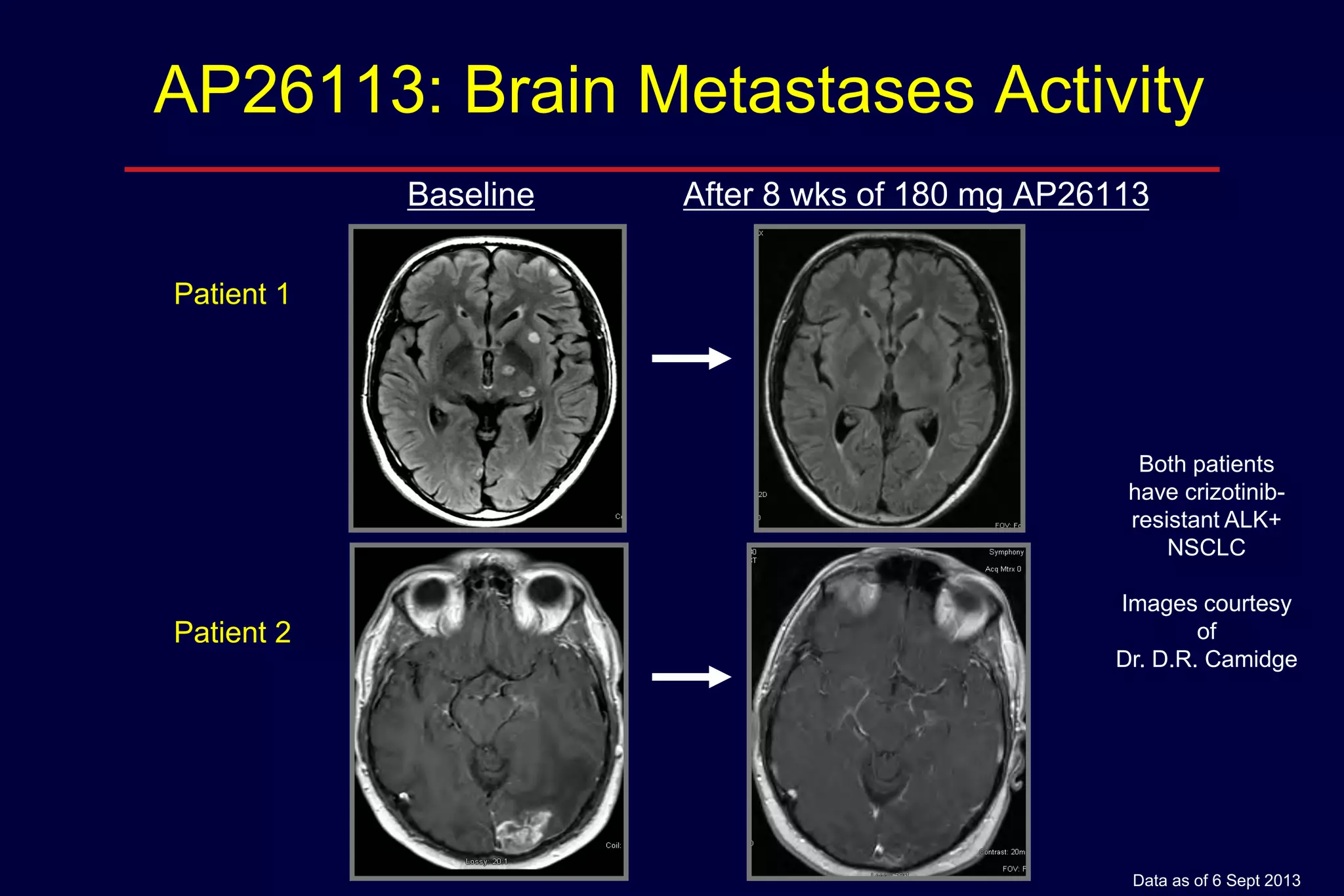 AP26113: Brain Metastases Activity
Baseline

After 8 wks of 180 mg AP26113

Patient 1

Both patients
have crizotinibresistant ALK+
NSCLC

Patient 2

Images courtesy
of
Dr. D.R. Camidge

Data as of 6 Sept 2013

 
